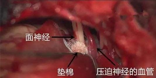 面肌痉挛最新最有效的治疗方法探索
