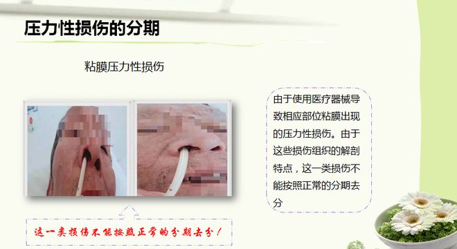 最新压力性损伤分期研究，巷子深处的秘密小店揭秘